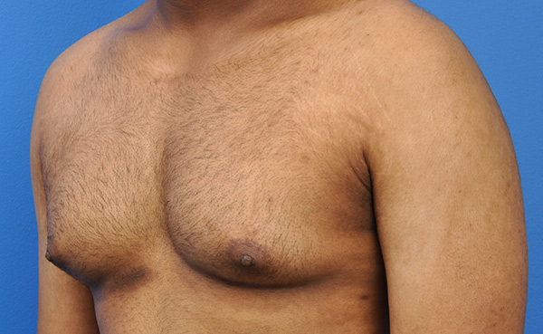 Gynecomastia