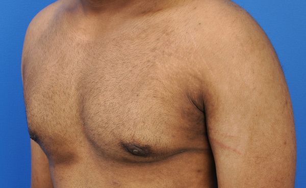 Gynecomastia