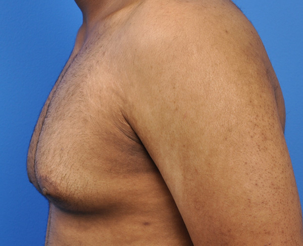 Gynecomastia