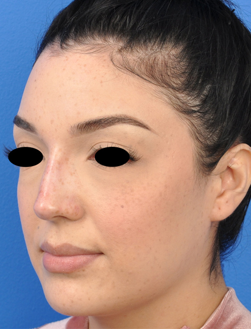 Non-Surgical Rhinoplasty