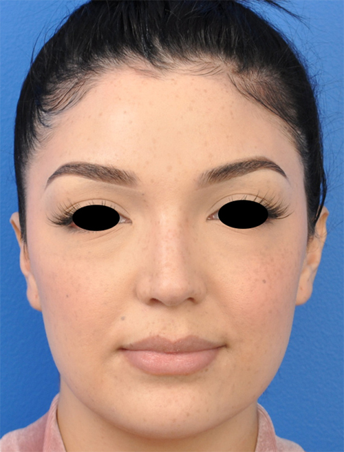 Non-Surgical Rhinoplasty