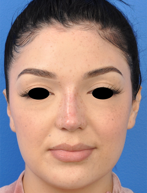 Non-Surgical Rhinoplasty