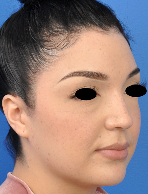 Non-Surgical Rhinoplasty