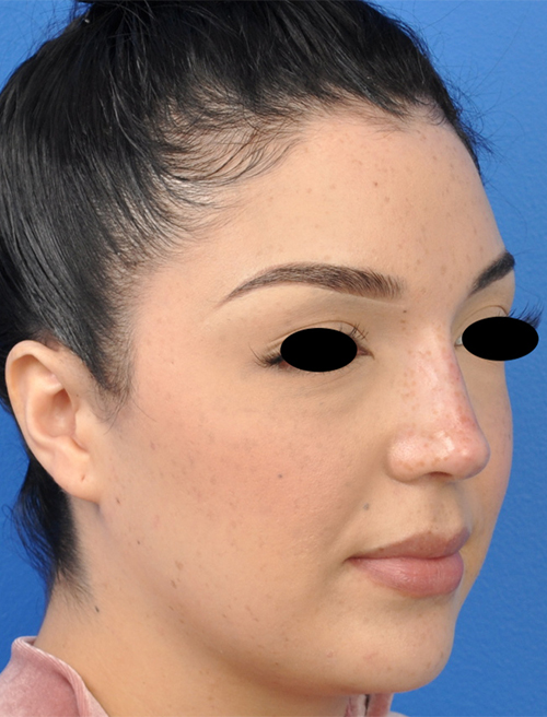 Non-Surgical Rhinoplasty