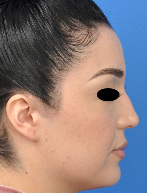 Non-Surgical Rhinoplasty