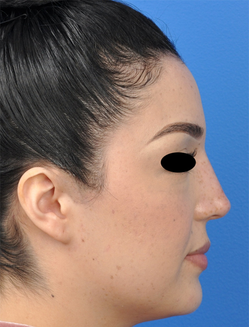 Non-Surgical Rhinoplasty