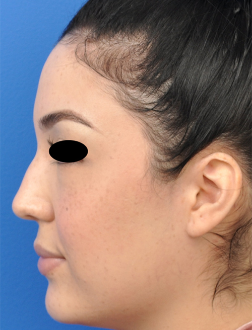 Non-Surgical Rhinoplasty