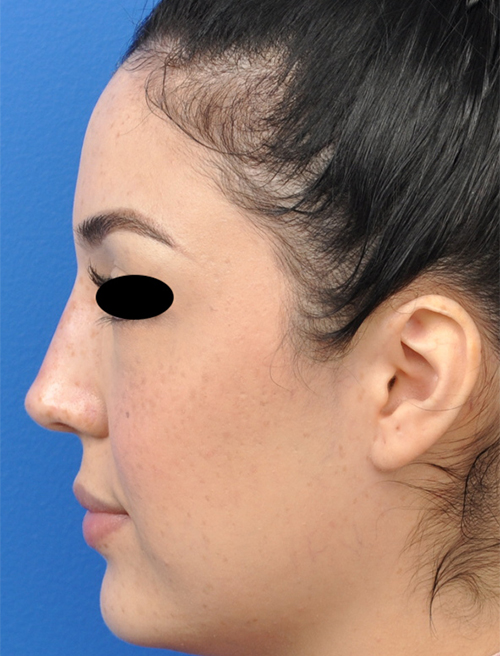 Non-Surgical Rhinoplasty