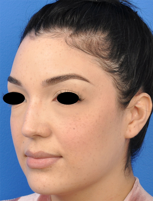 Non-Surgical Rhinoplasty