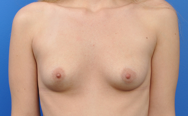 Breast Augmentation