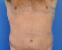 Male Abdominal Etching