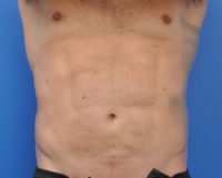 Male Abdominal Etching