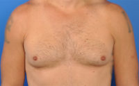 Gynecomastia