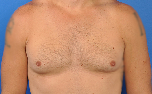 Male Gynecomastia Before and After