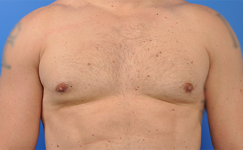 Male Gynecomastia Before and After