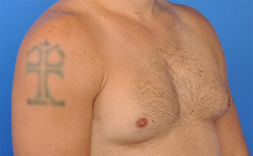 Gynecomastia