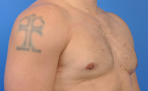 Gynecomastia