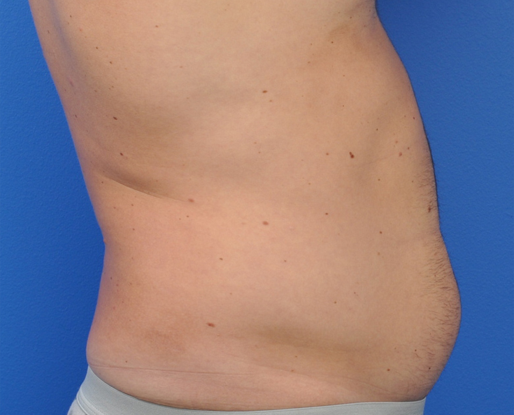 Male Abdominal Etching