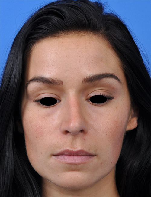 Non-Surgical Rhinoplasty