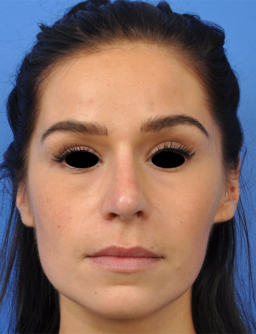 Non-Surgical Rhinoplasty