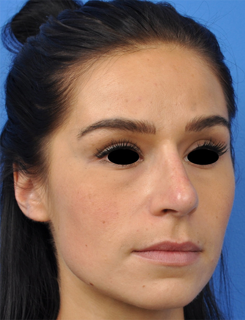 Non-Surgical Rhinoplasty