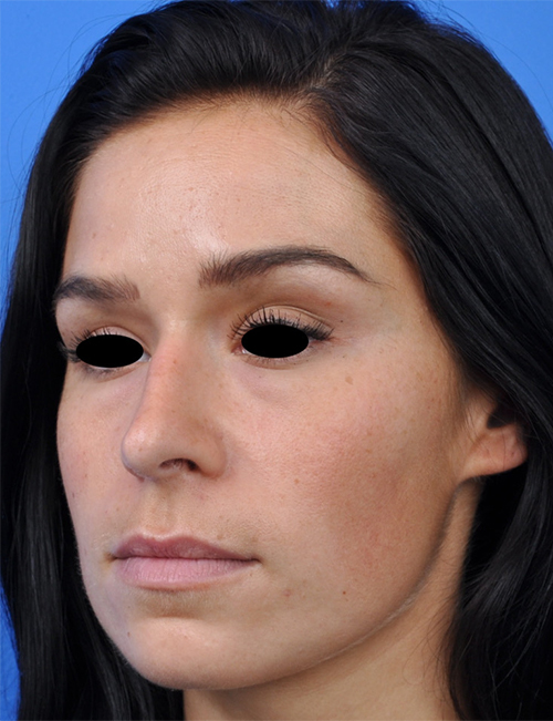 Non-Surgical Rhinoplasty