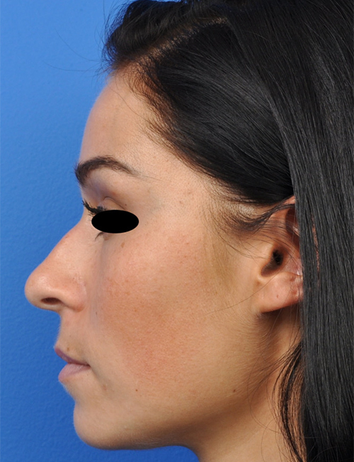 Non-Surgical Rhinoplasty