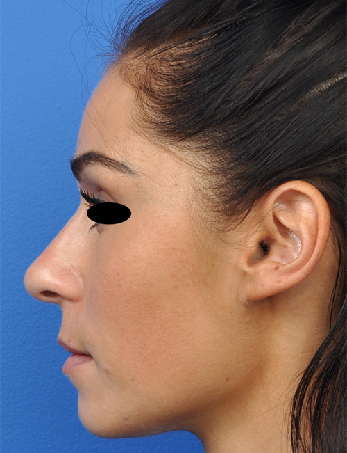 Non-Surgical Rhinoplasty