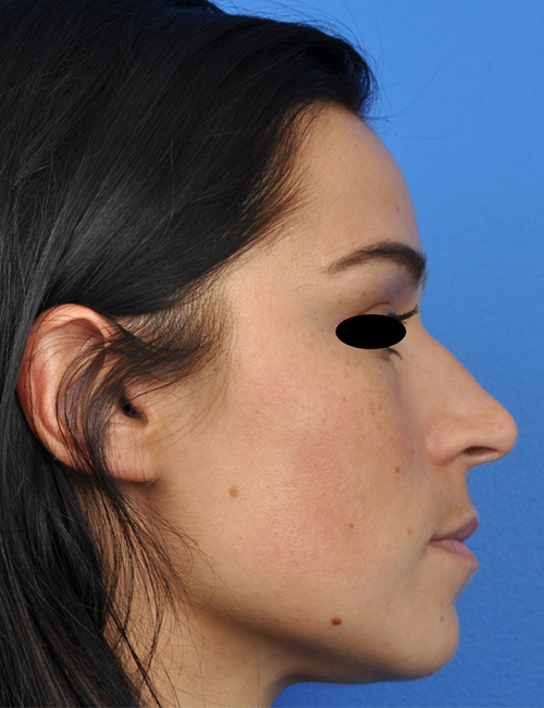 Non-Surgical Rhinoplasty