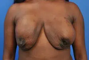 Before breast reconstruction Front View