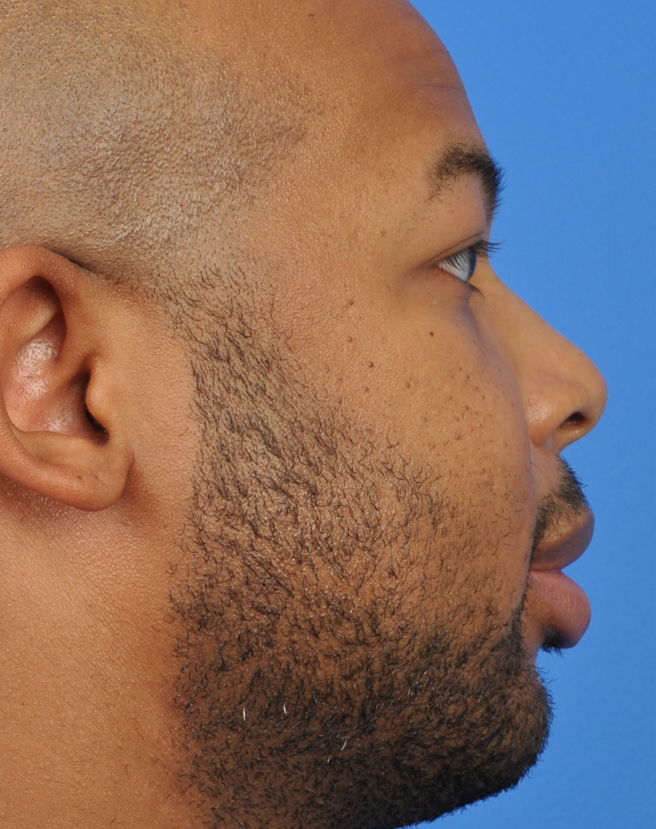 Male Rhinoplasty