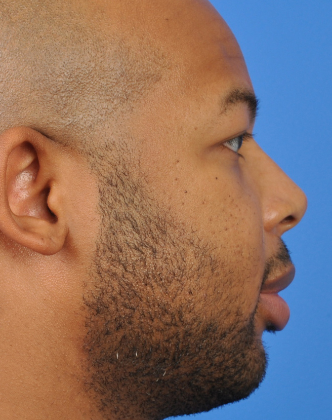 Male Rhinoplasty