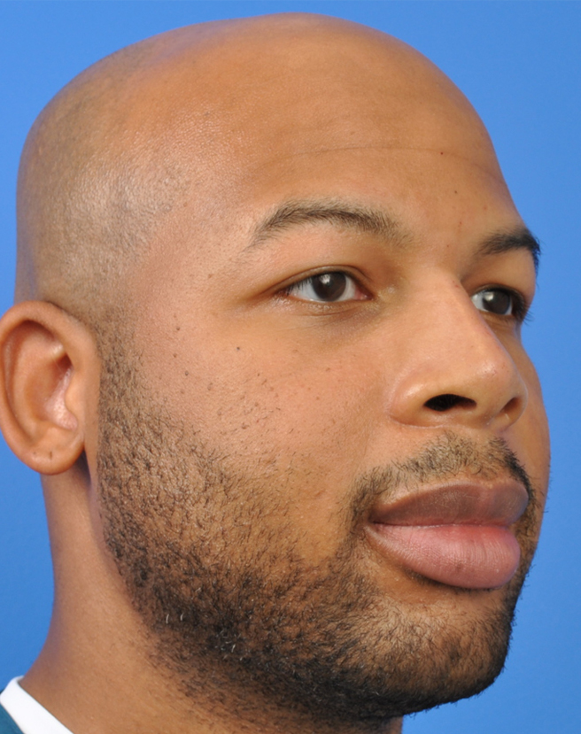 Male Rhinoplasty