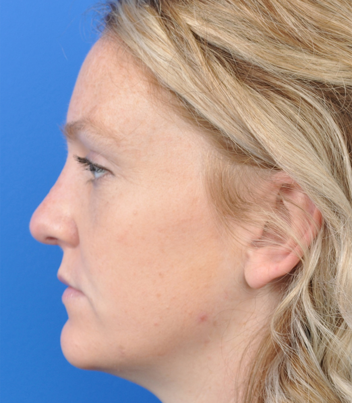 Rhinoplasty