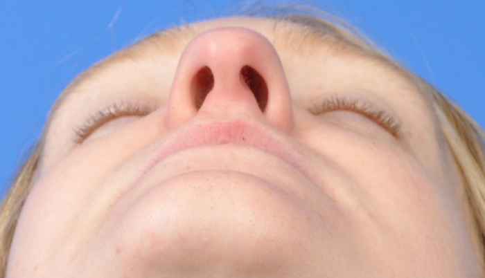 Rhinoplasty