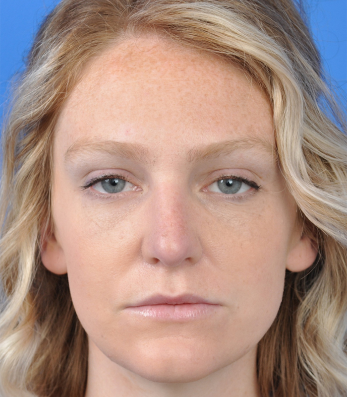 Rhinoplasty