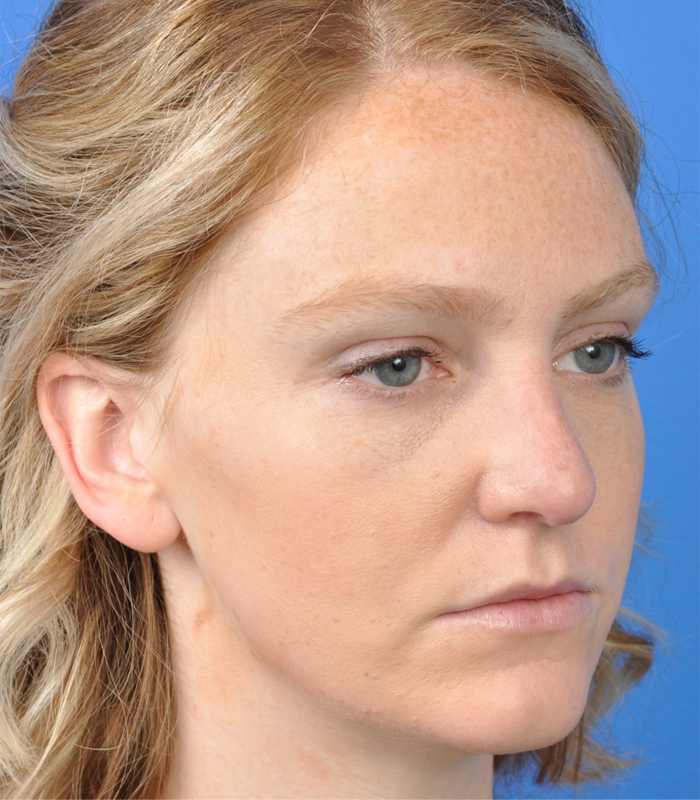 Rhinoplasty