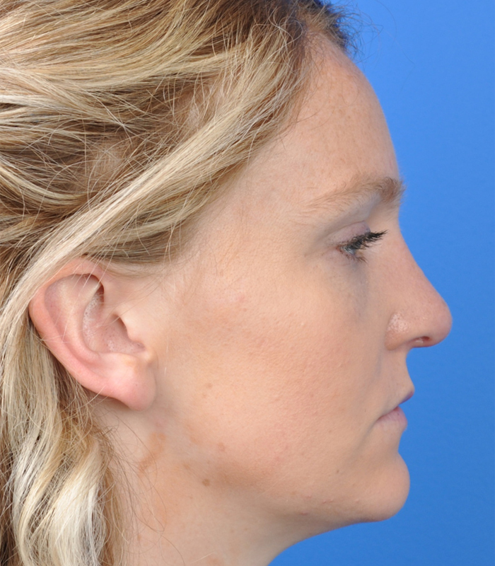 Rhinoplasty