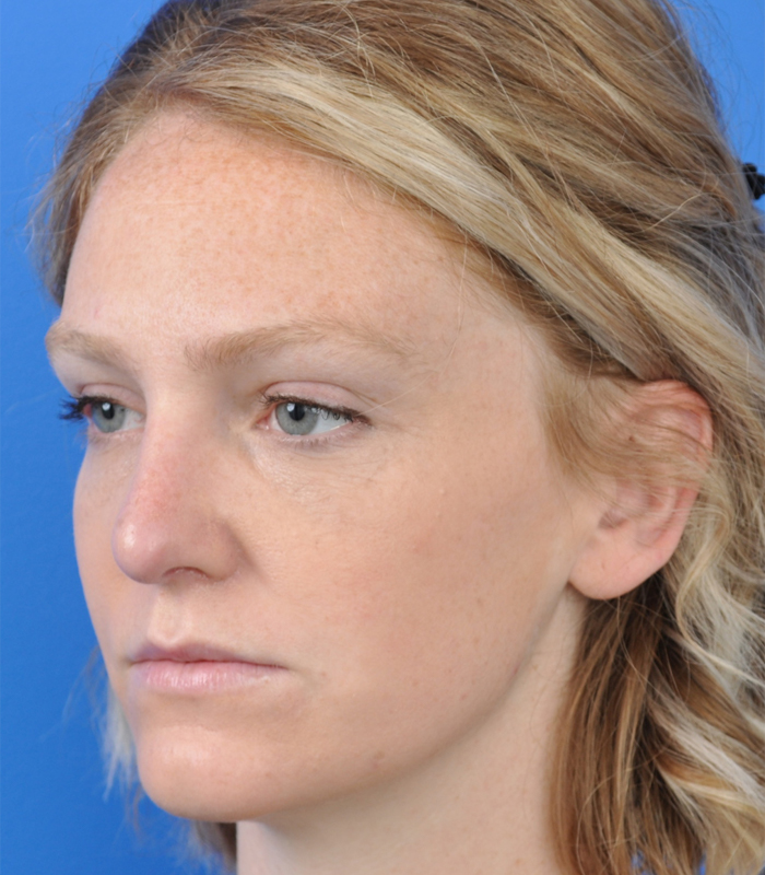 Rhinoplasty