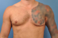 Chest Implants