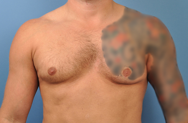 Male Chest Implants Before and After