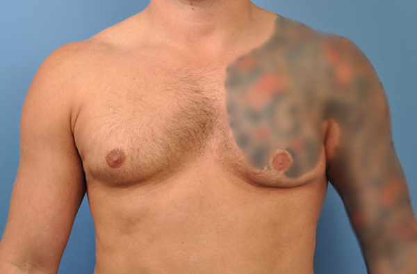 Chest Implants