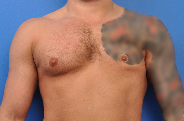 Male Chest Implants Before and After