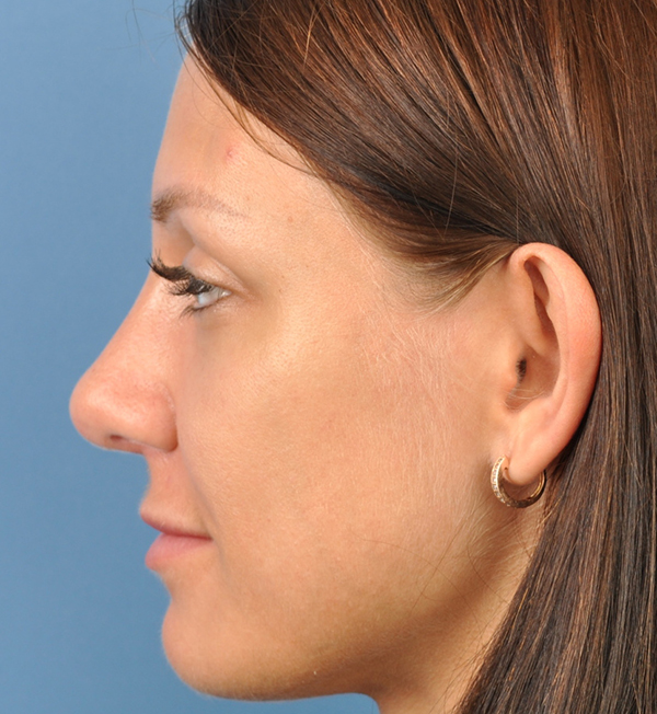 Rhinoplasty