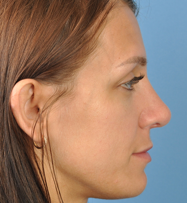 Rhinoplasty