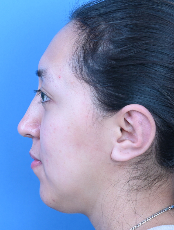 Otoplasty