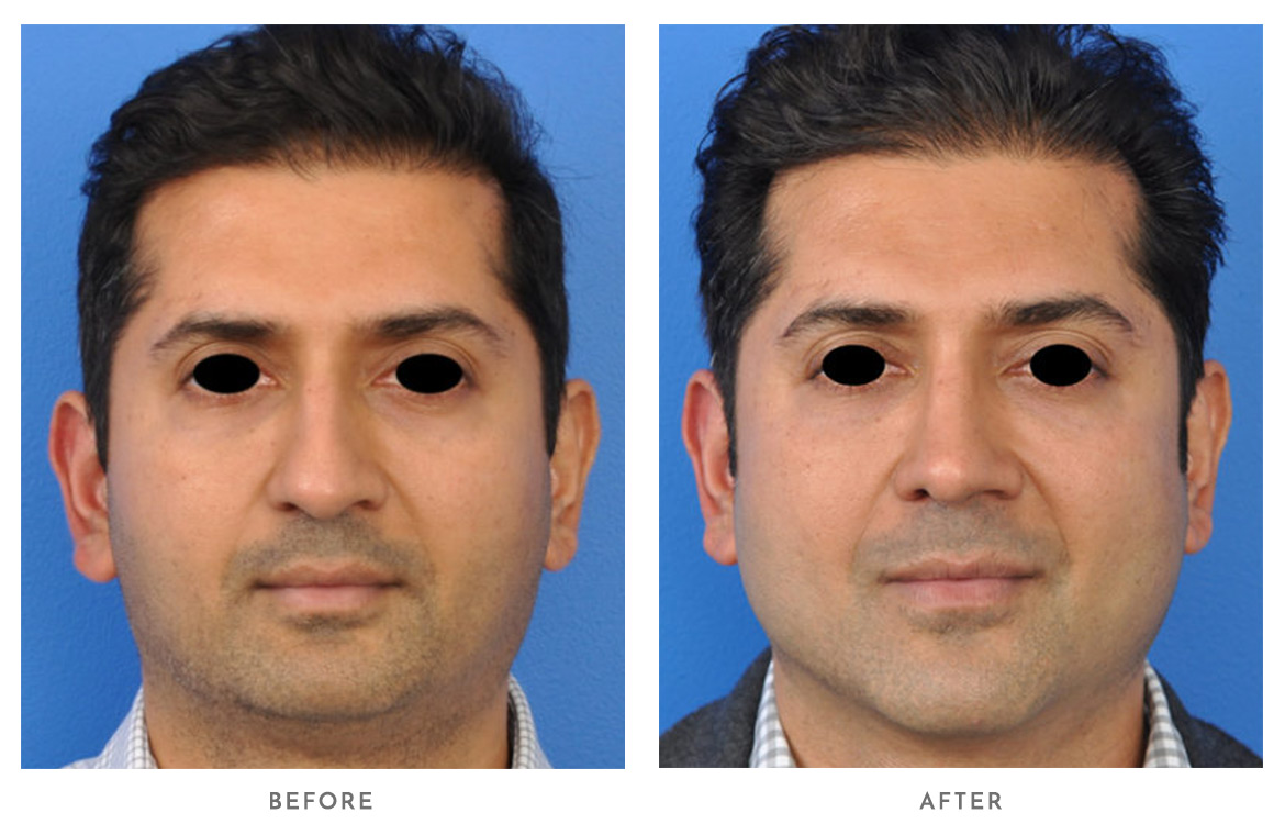 Male Genioplasty Before and After | PSC of Chicago