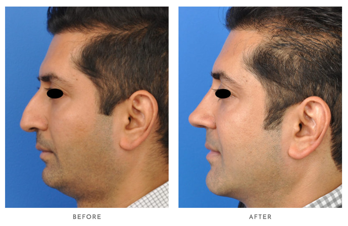 Male Genioplasty Before and After | PSC of Chicago