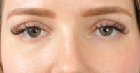 Blepharoplasty