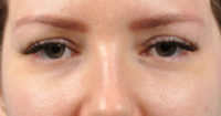 Blepharoplasty